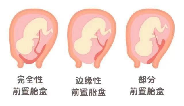 C:\Users\admin\Desktop\20230203帆狀胎盤(pán)血管前置\efd6c07b943e5dafb9b079023d95942.jpg