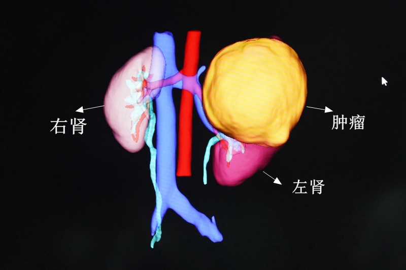 C:\Users\admin\Desktop\20230522泌尿外科10歲女童左腎長巨大腫瘤，宛如第三個(gè)腎臟\DSC06254.JPG