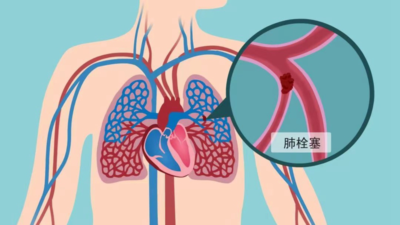 20250217 呼吸科 肺栓塞6.jpg